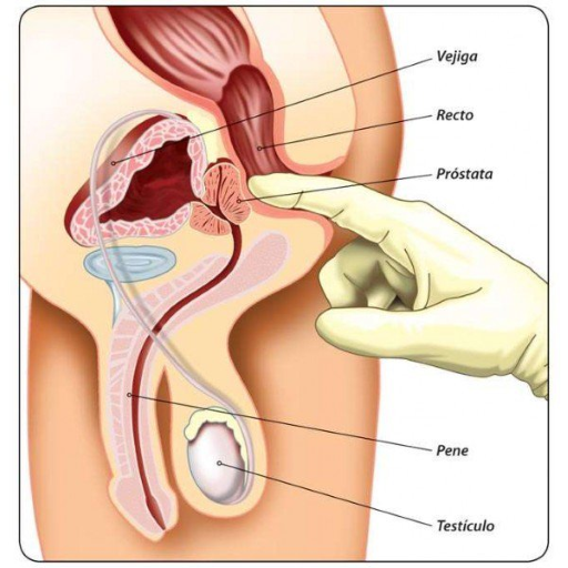 Pathology of prostate cancer ncbi. Potencia és prosztatitis tabletták