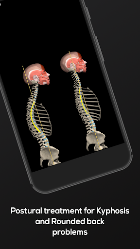 Screenshot of Kyphosis & Rounded Back by M&M