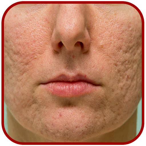 Acne Scar Removal