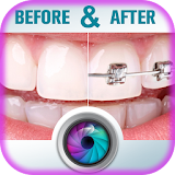 Teeth Braces Before and After icon