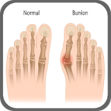 How to Get Rid of Bunions Without Surgery icon