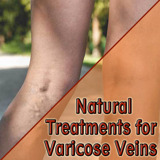 varicose veins - Romanian translation – Linguee