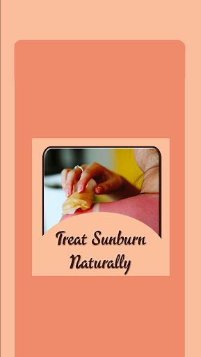 Treat Sunburn Naturally
