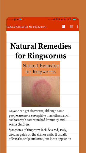 Natural Remedies for Ringworms