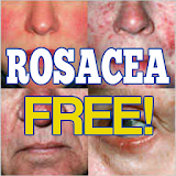Rosacea Free Forever! icon