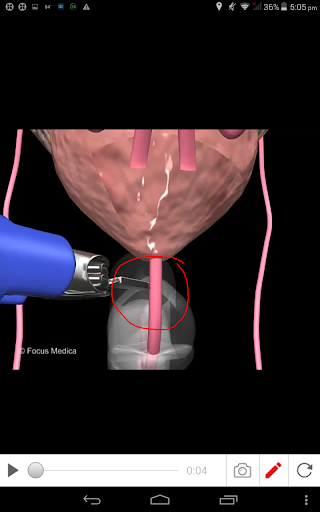 Prostate cancer Screen 3