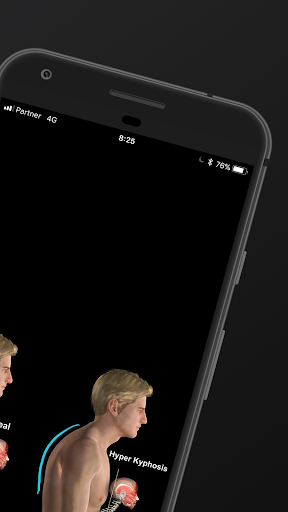 Screenshot of Kyphosis & Rounded Back by M&M