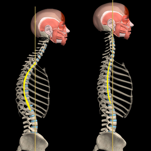 Kyphosis & Rounded Back by M&M  Icon