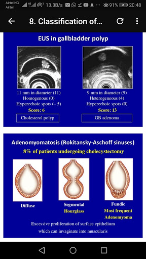 Ultrasound of Gallbladder