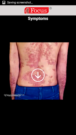 Psoriatic Arthritis Screen 3