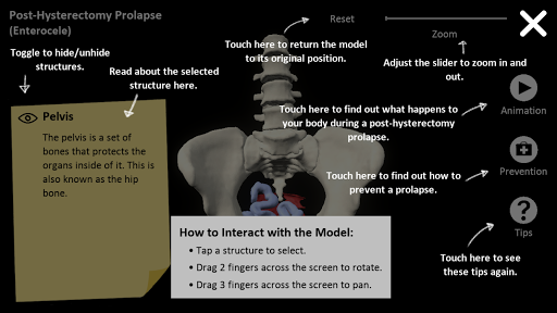 myProlapse: Anatomy of Post-Hy Screen 2