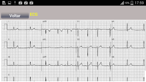 Arritmias Cardíacas 5.0