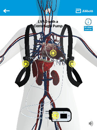 LVAD by Abbott Screen 3