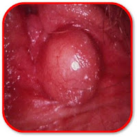 How to Treat Vaginal Cysts