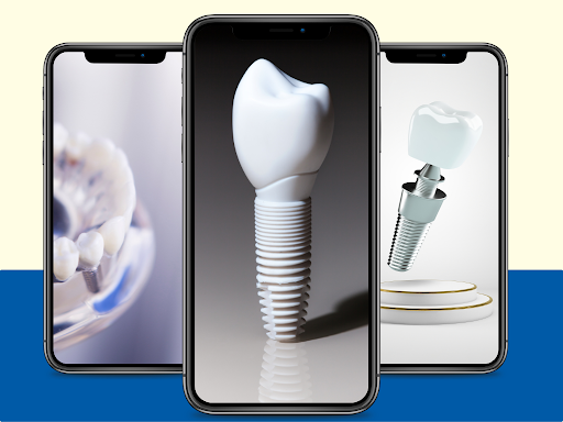 نصائح مهمة عند زراعة الاسنان