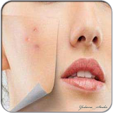 Recipe for removing Acne Scars easily icon