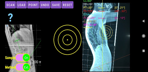 Spinopelvic balance App screenshot 13