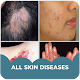 Skin diseases and treatment