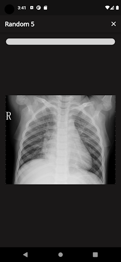 X-Ray Flashcards (Pneumonia) Screen 3