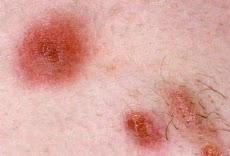 Skin infections guideのおすすめ画像1