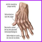 Remedios Caseros Artritis