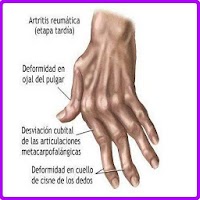 Remedios Caseros Artritis