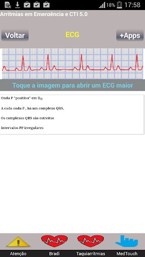 Arritmias Cardíacas 5.0
