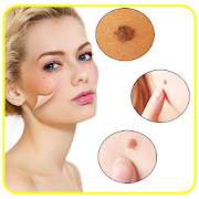 Skin Moles Treatment, Remedies to removing them
