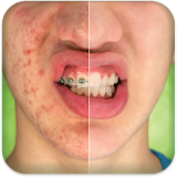 Pimple Remover icon