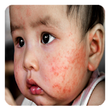 Eczema in children icon