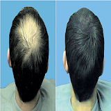 Home Remedies for Hair Loss icon