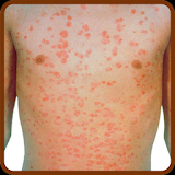 Psoriasis Natural Treatment Guide icon