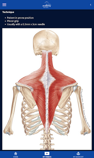 DGSA Dry Needling Videos screenshot 12