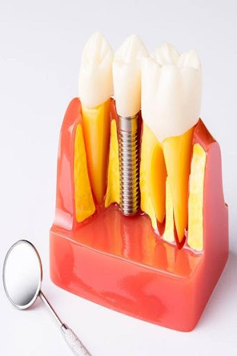 Dental Implants