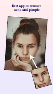 Pimple Remover, Eraser – Face Beauty Maker 2