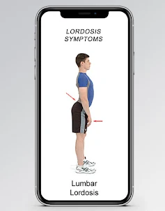 Lordosis Exercises - Lumbar