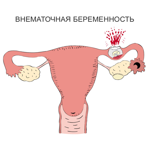 Яичниковая Беременность Фото