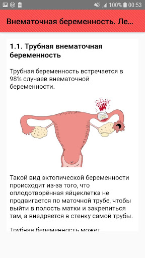 Что такое внематочная беременн