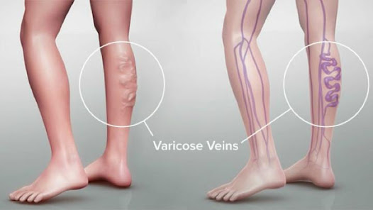 Captura 1 varicose veins guide android