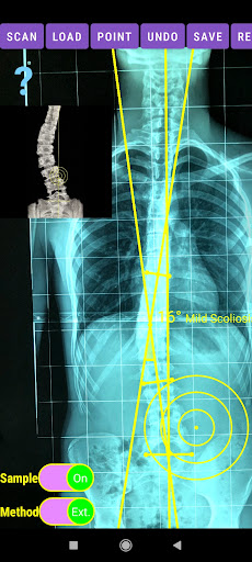 Cobb Angle App screenshot 5