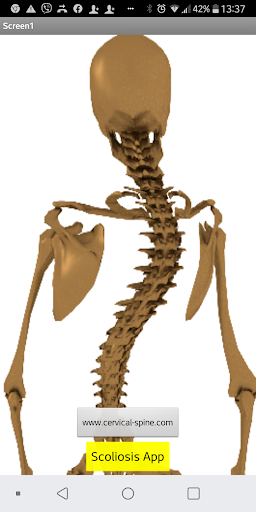 Scoliosis-early detection Screen 2