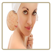Acne & Pimples (Home Care)