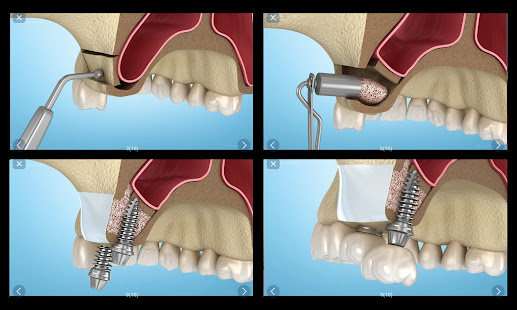 Dental 3D Illustrations for patient education