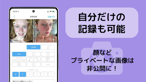 アトピー見える化アプリ-アトピヨ、アレルギー肌荒れかゆみ対策 Screen 2