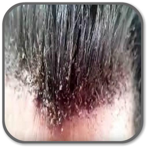 How to Get Rid of Lice