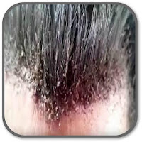 How to Get Rid of Lice