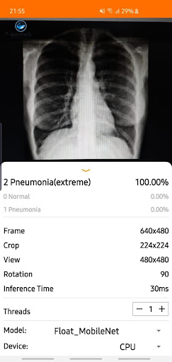 Chest X-Ray Classifier screenshot for Android
