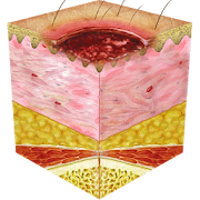 Norton Scale 4 Pressure Ulcer