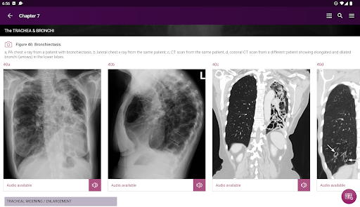 Chest X-Ray Interpretation screenshot 22