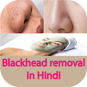 Blackheads Removal in Hindi